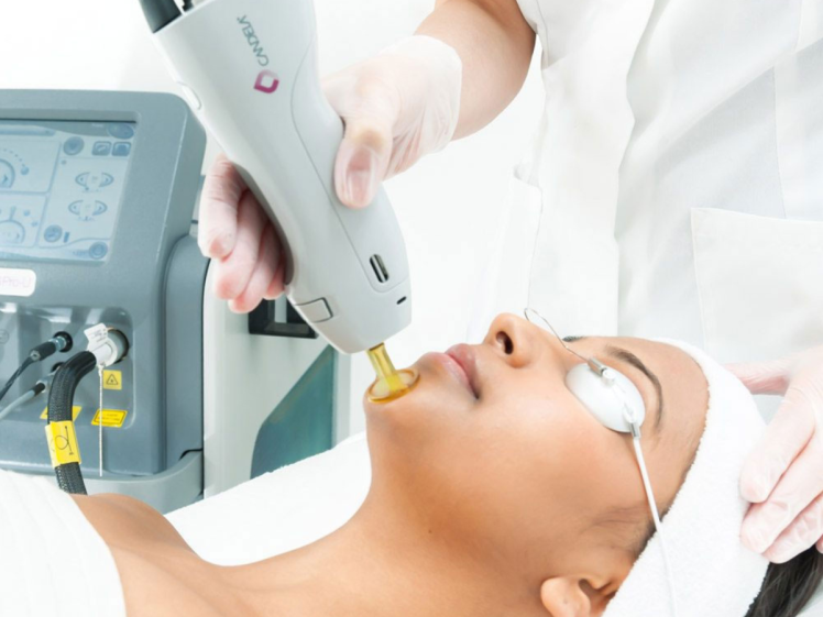 تفاوت لیزر کندلا با سایر دستگاههای لیزر موهای زائد